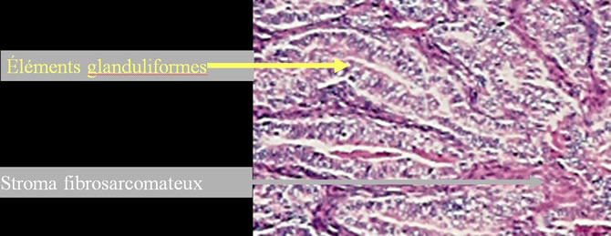 sarcome tenosynovial