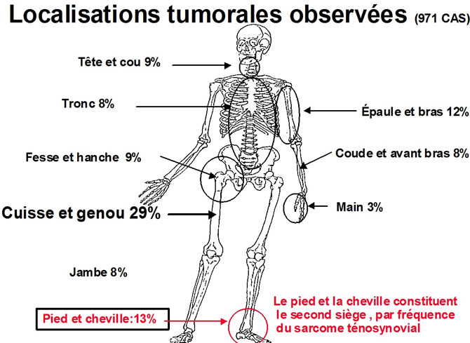 sarcome tenosynovial