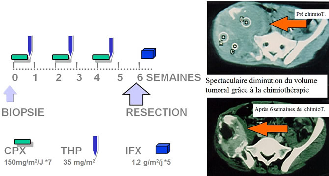 Ostéosarcome chimiothérapie