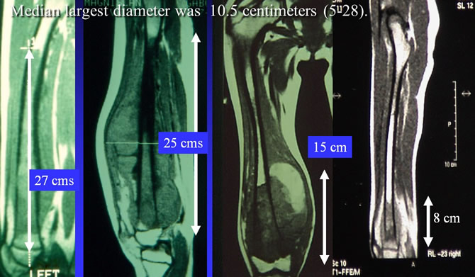 osteosarcoma