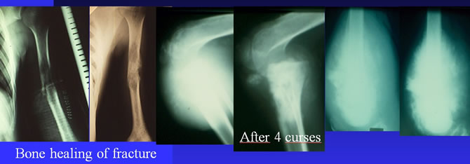 osteosarcoma