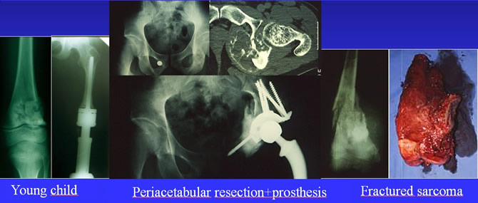 osteosarcoma