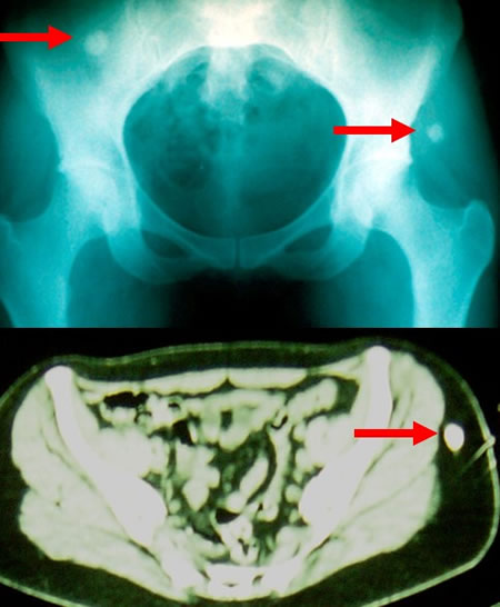 osteosarcome juxtacortical