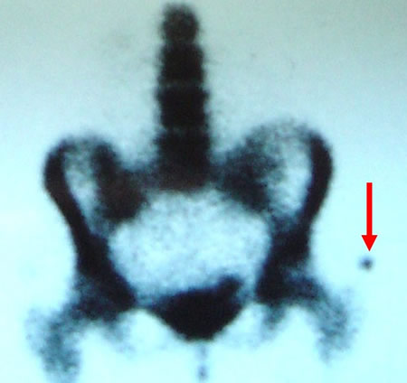 osteosarcome juxtacortical