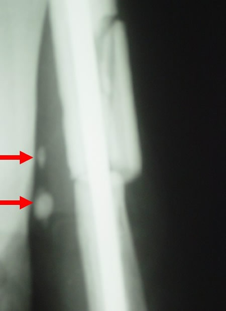 osteosarcome juxtacortical