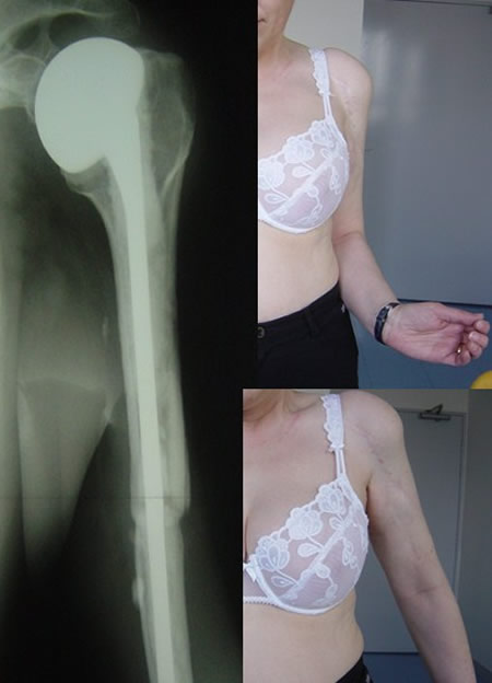 osteosarcome juxtacortical