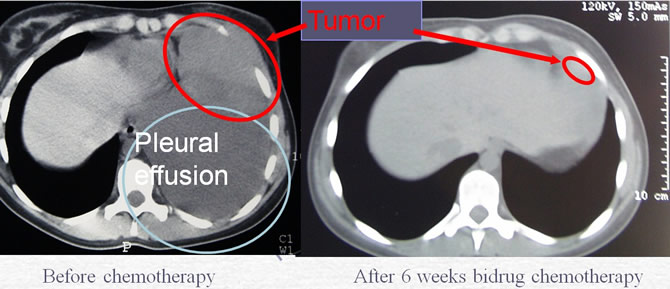 Ewing's sarcoma