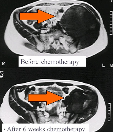 Ewing's sarcoma