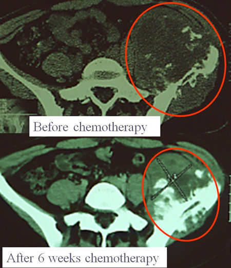 Ewing's sarcoma