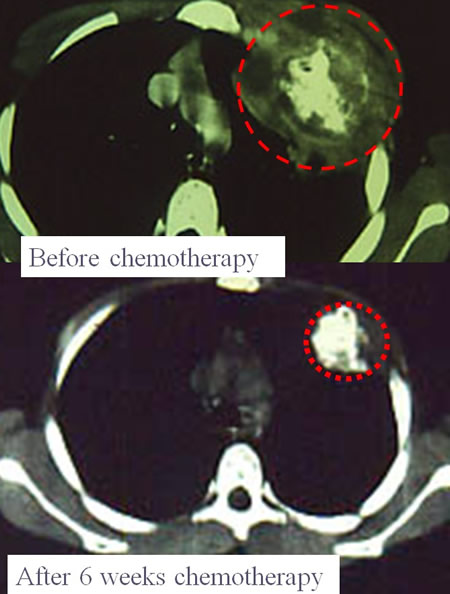 Ewing's sarcoma