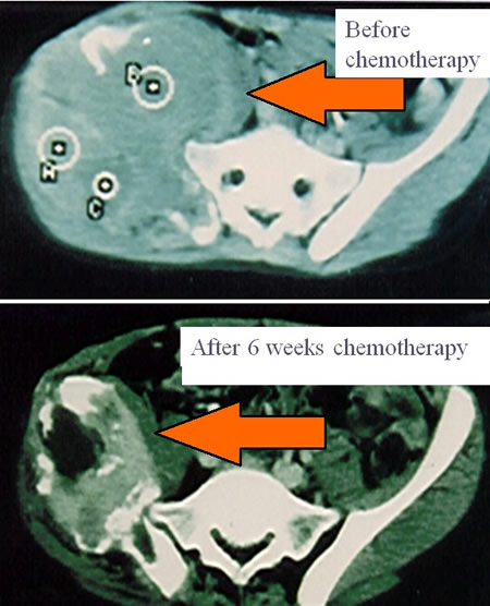 Ewing's sarcoma