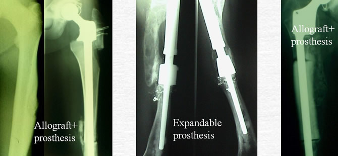 Ewing's sarcoma