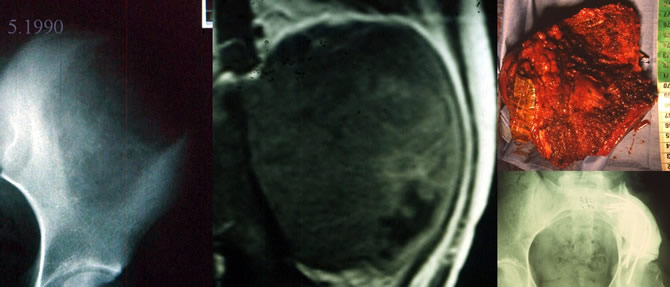 Ewing's sarcoma