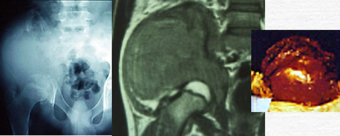 Ewing's sarcoma