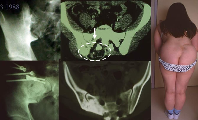 Ewing's sarcoma