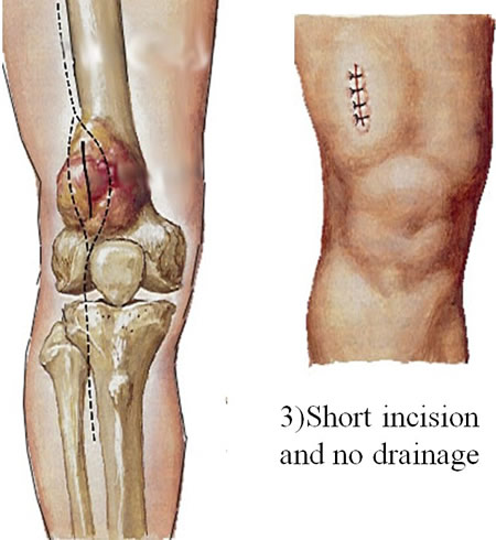 Pitfalls of biopsy and consequences