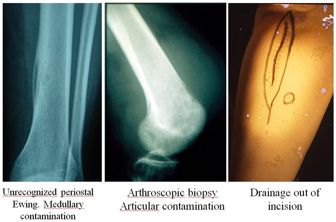 Pitfalls of biopsy and consequences