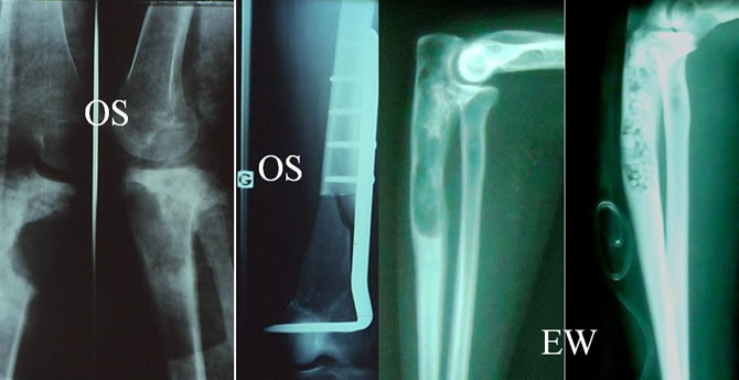 Pitfalls of biopsy and consequences