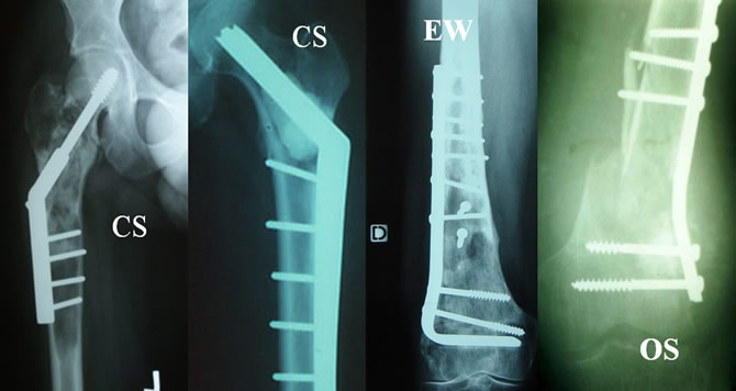 Pitfalls of biopsy and consequences