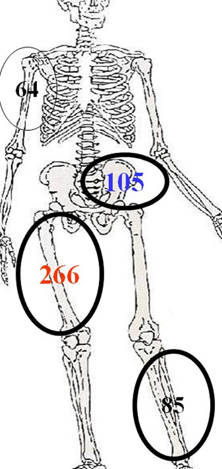 envahissement neurovasculaire sarcomes osseux