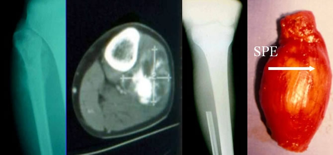 envahissement neurovasculaire sarcomes osseux