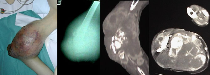 envahissement neurovasculaire sarcomes osseux