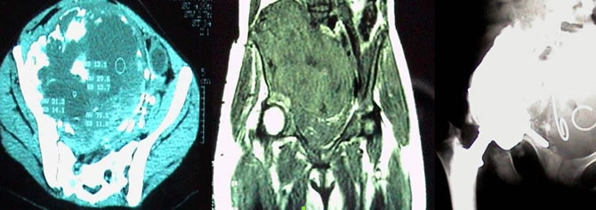 envahissement neurovasculaire sarcomes osseux