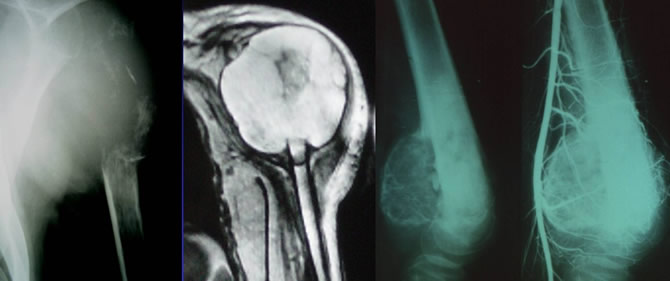 envahissement neurovasculaire sarcomes osseux