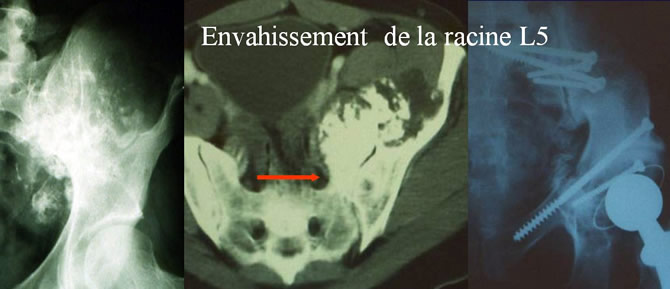 envahissement neurovasculaire sarcomes osseux