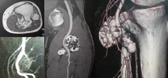 envahissement neurovasculaire sarcomes osseux