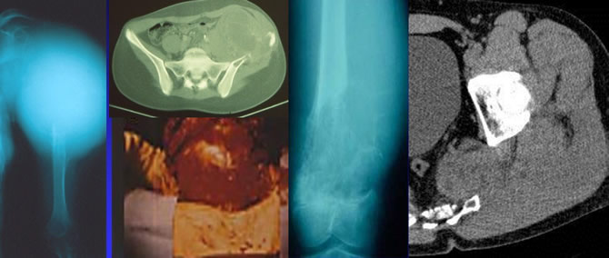 envahissement neurovasculaire sarcomes osseux