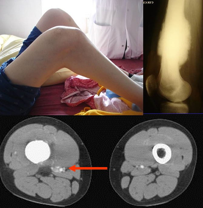 envahissement neurovasculaire sarcomes osseux