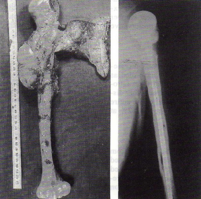 fibrosarcoma