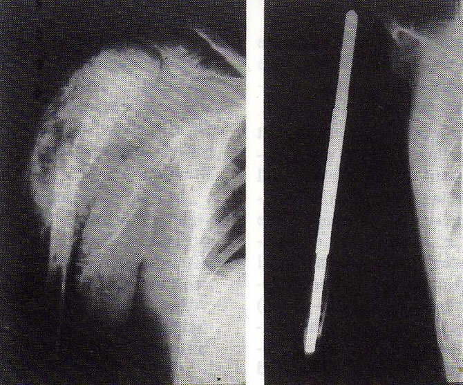 fibrosarcoma