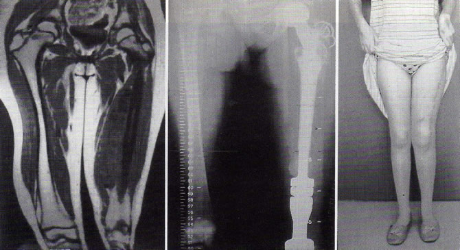 fibrosarcoma