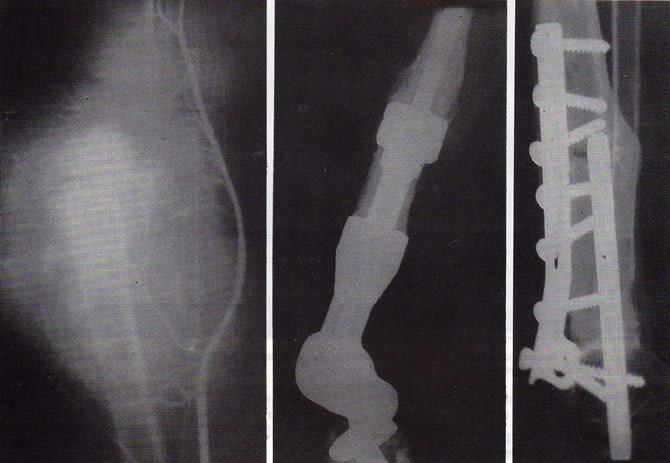 fibrosarcoma