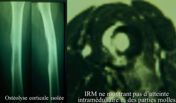 IRM diagnostic précoce