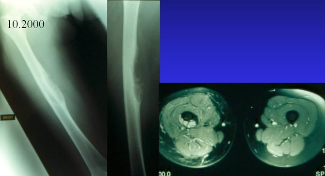 IRM diagnostic précoce