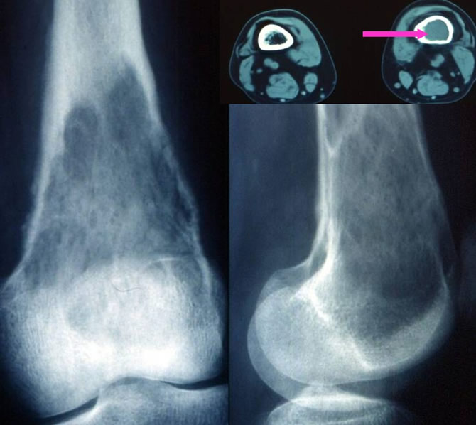 Fibrosarcomes