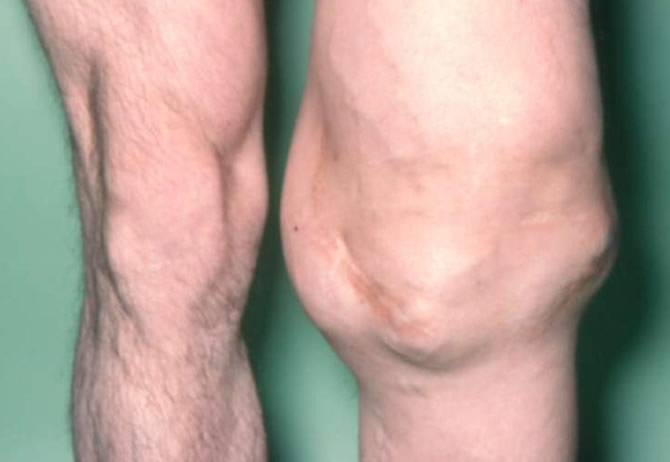  tumeur du genou