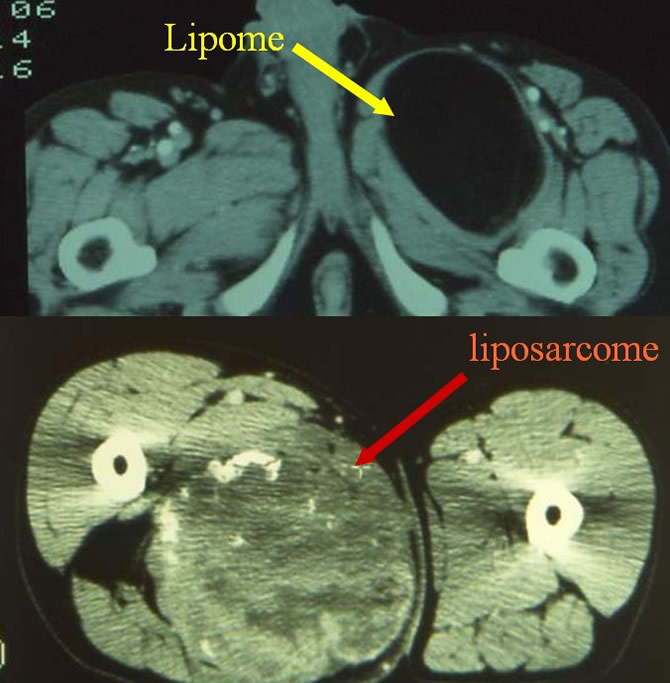  Lipomes et liposarcomes