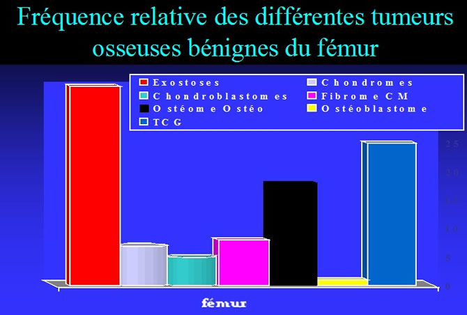 Tumeurs Osseuses Bénignes fémur