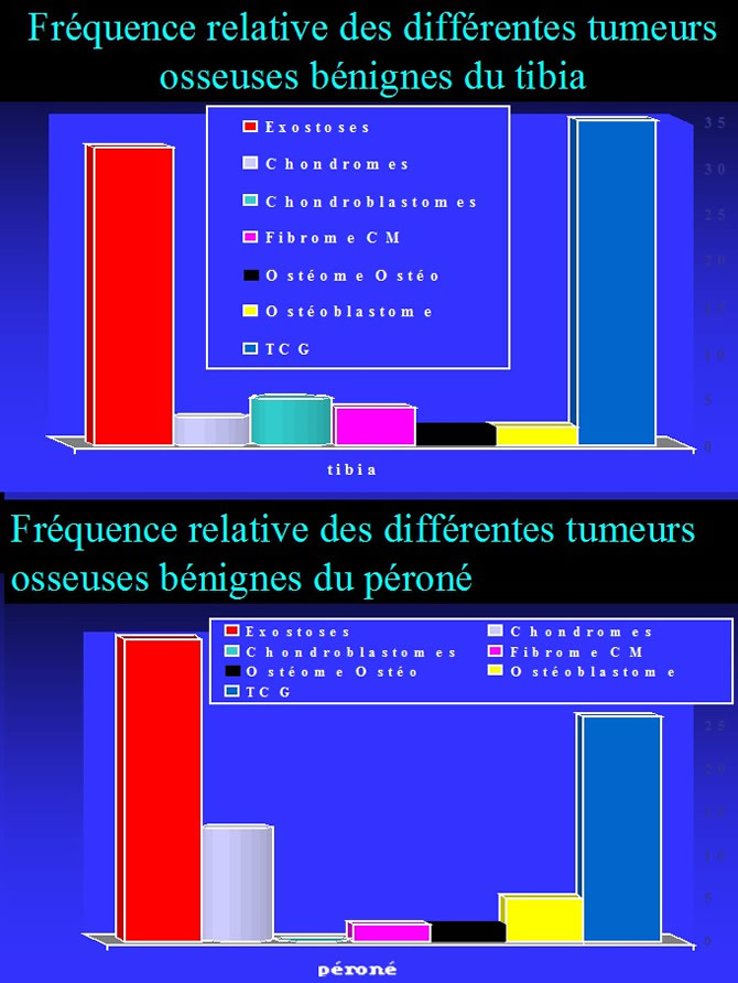 Tumeurs Osseuses Bénignes tibia péroné