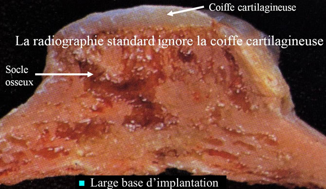 coiffe cartilagineuse