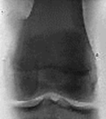 cartilage radio transparent