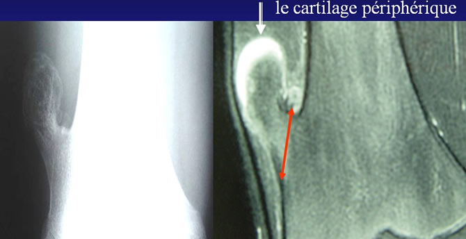 IRM le cartilage périphérique