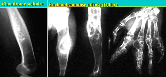 chondromes Métaphyses