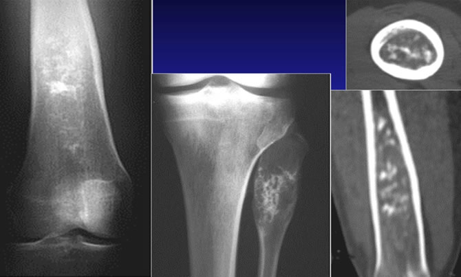 Radiologie chondromes