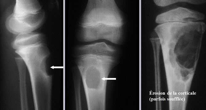 Radiologie Firomes chondromyxoides