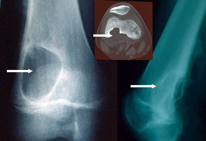 fibromes chondromyxoïdes fémur